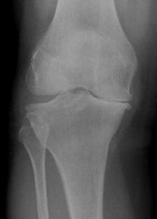x-ray image of knee bone